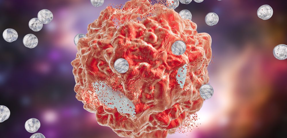 Radiation-delivering Microspheres Fight Liver Cancer as Well as Chemo, Clinical Trial Indicates