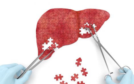SIR-Spheres Radiation Therapy Increases Chance Liver Cancer Can Be Operated on, Study Reports
