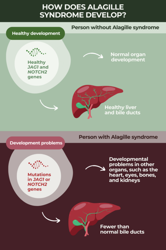 How alagille syndrome develops infographic