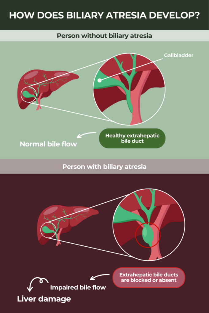 How biliary atresia develops infographic