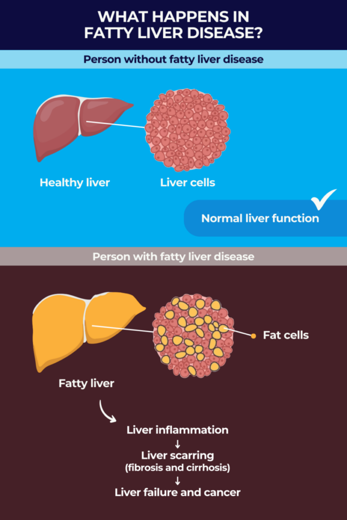 Fatty liver disease infographic