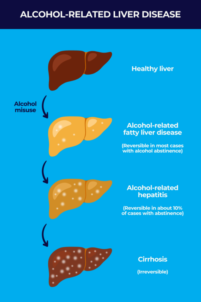 Stages of alcoholic liver disease