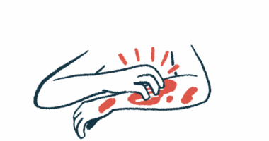 In this illustration, a person is seen in close-up view scratching an itchy rash on their left arm using their right hand.