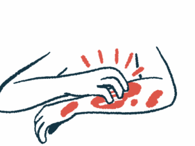 In this illustration, a person is seen in close-up view scratching an itchy rash on their left arm using their right hand.