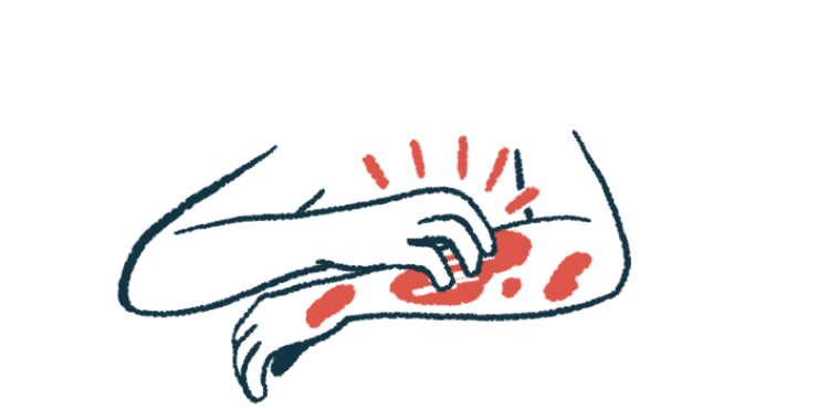 In this illustration, a person is seen in close-up view scratching an itchy rash on their left arm.