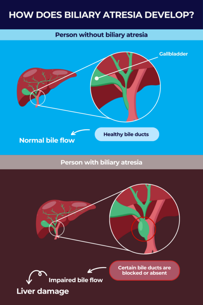 How biliary atresia develops