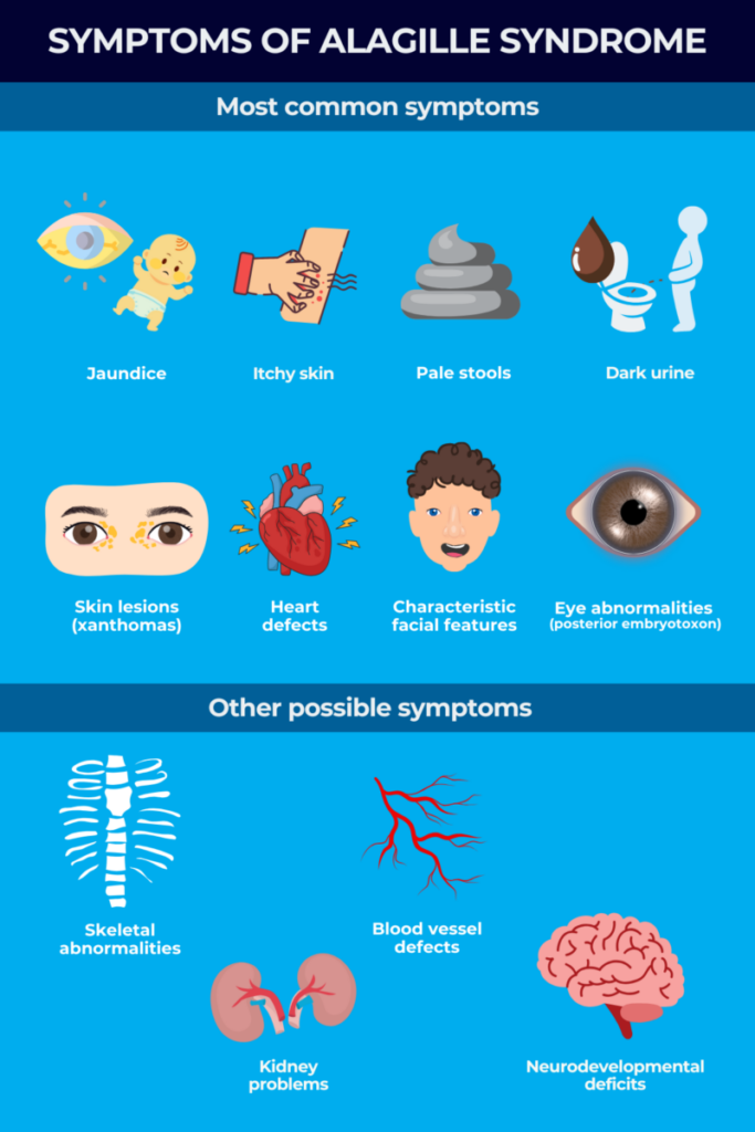 Symptoms of alagille syndrome