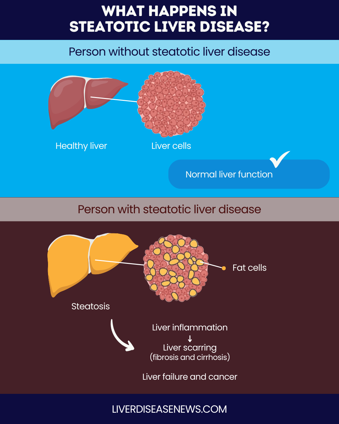 Steatotic liver disease: Everything you need to know | Liver Disease News